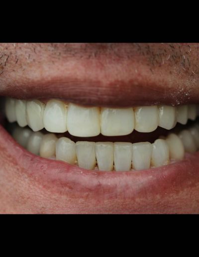 Focus Dentistry Biorejuvenation Smile Gallery