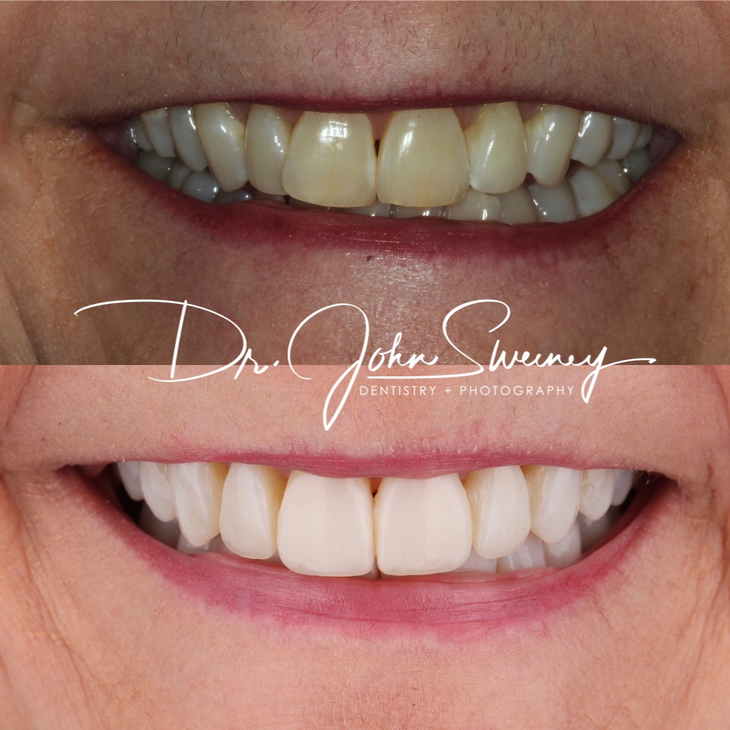 Focus dentistry patient before and after photo