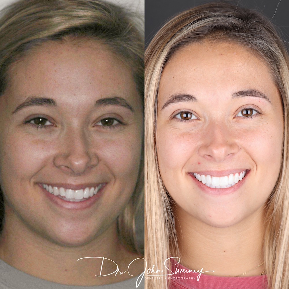 FOCUS Dentistry before and after photo