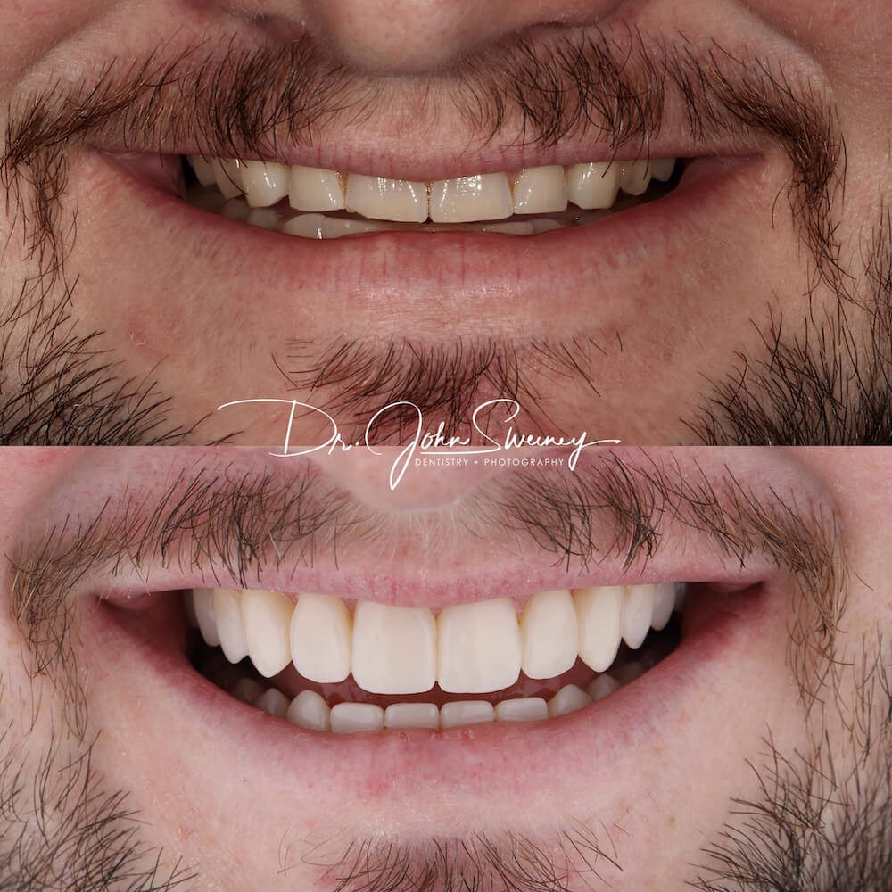 Focus dentistry patient before and after photo