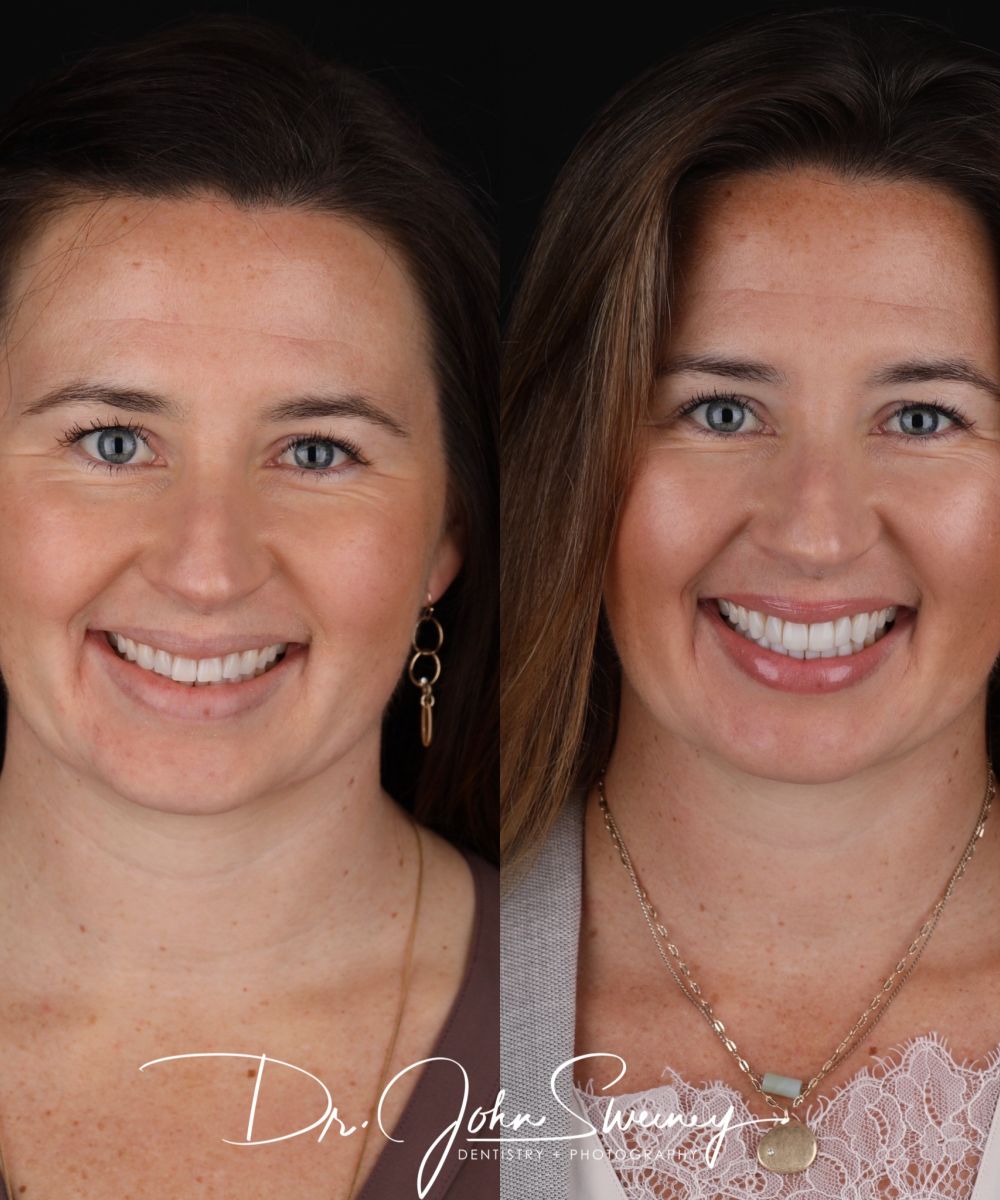 Focus dentistry before and after patient photo