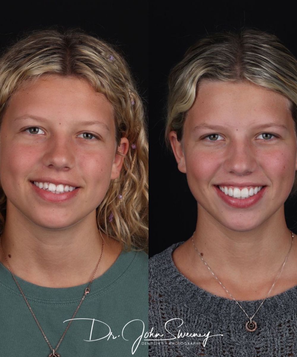 Focus-Dentistry-Case-Before-After