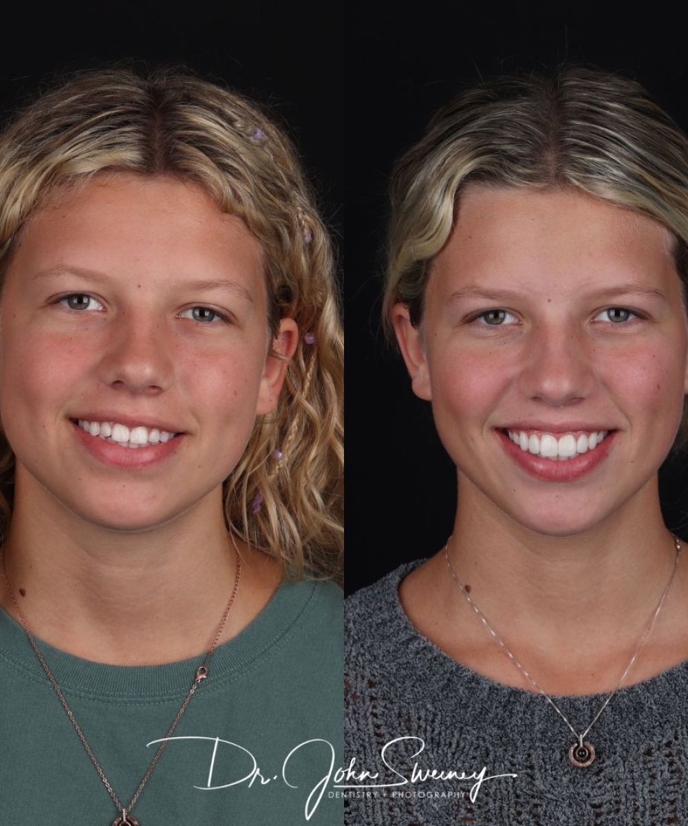 Focus-Dentistry-Case-Before-After