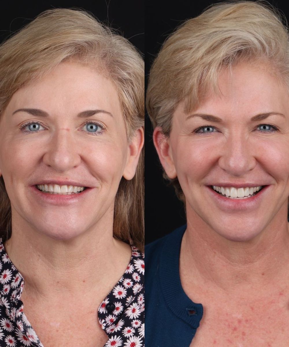 Focus-Dentistry-Case-Before-After